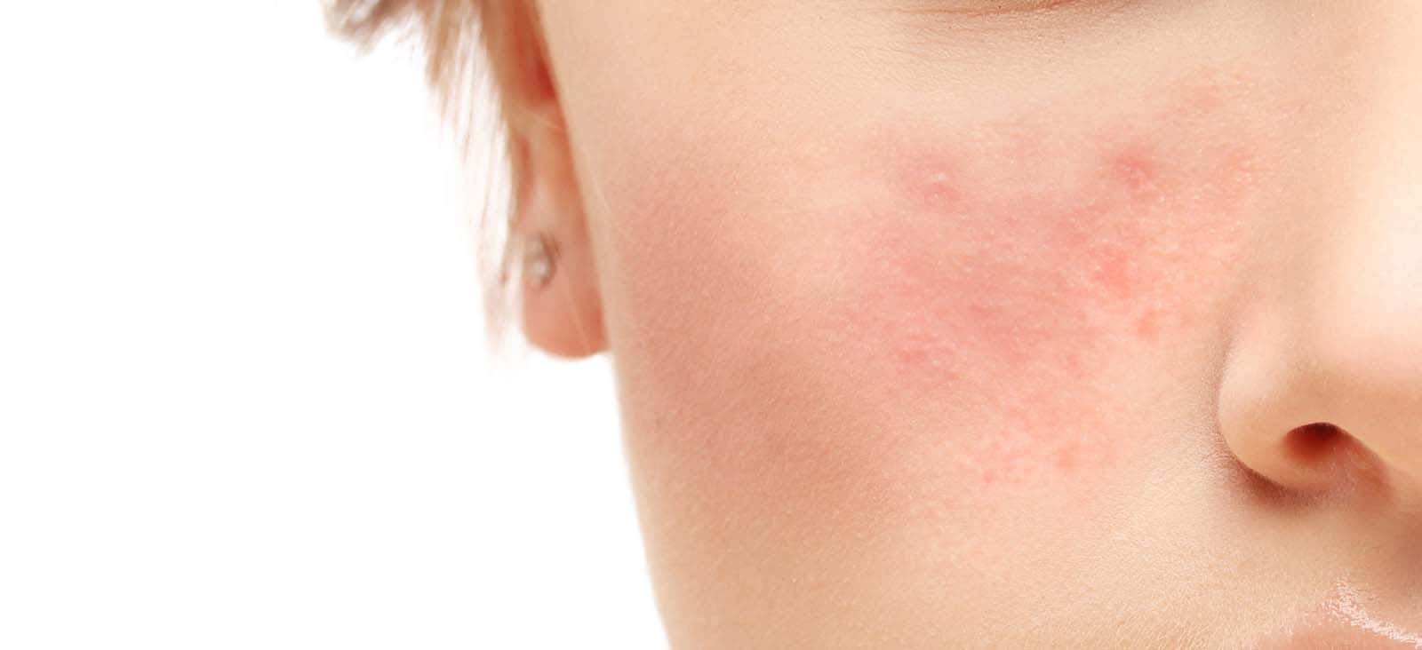 بیماری‌های خودایمنی